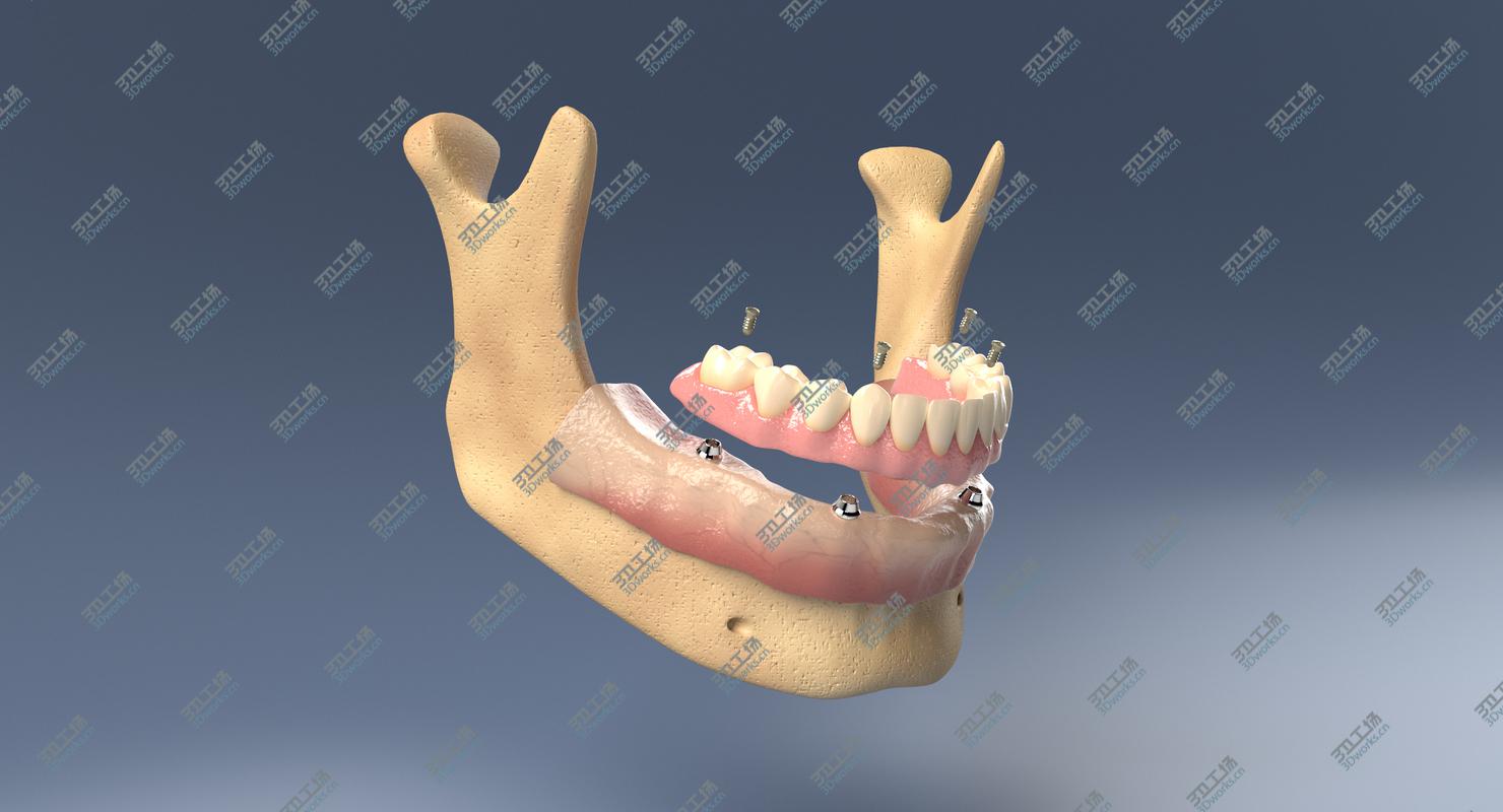 images/goods_img/2021040231/3D Denture with Dental Implants/1.jpg